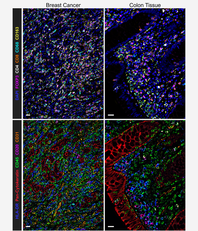 Discovery Panel in breast cancer and colon tissue