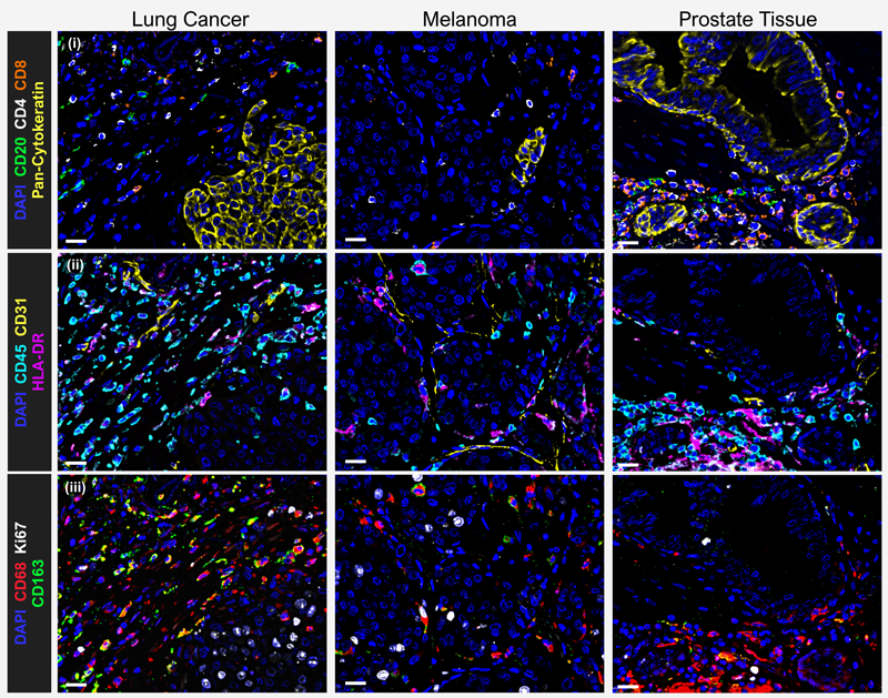 Discovery Panel in lung, melanoma, and prostate